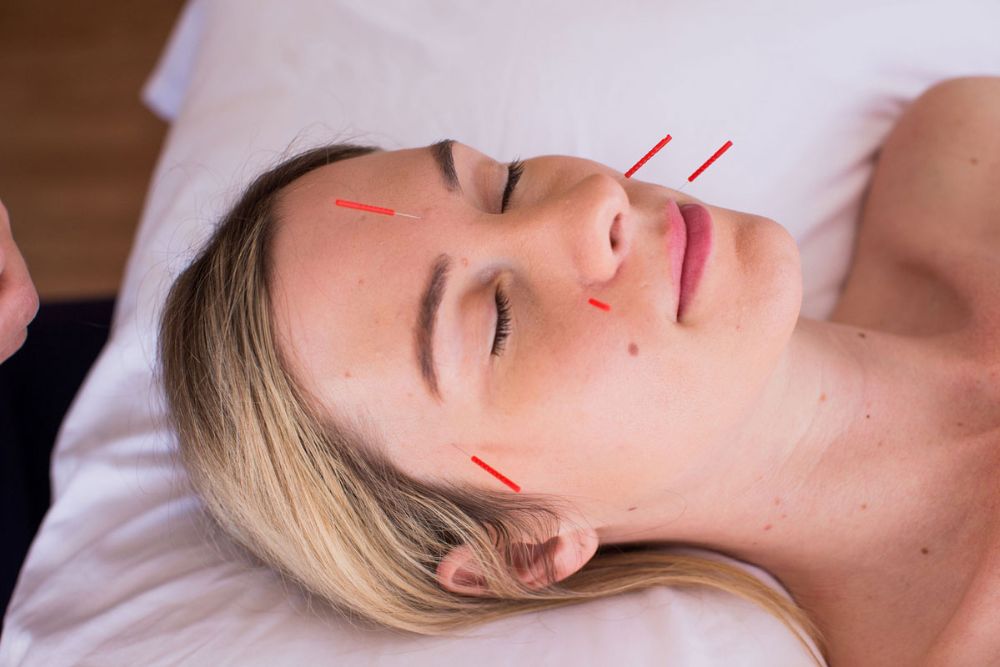 Cosmetic Acupuncture needles on face