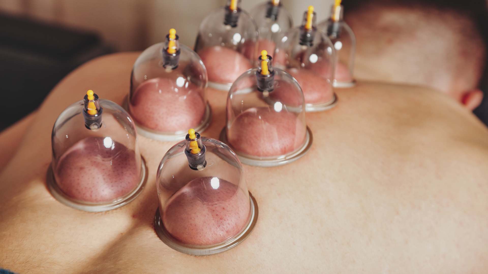 How Acupuncture Can Help Relieve Muscle Knots and Tension - Calm San Diego